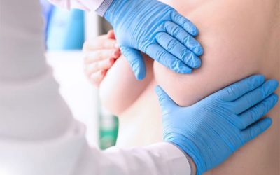 Réduction mammaire cicatrices, prise en charge & avant-après