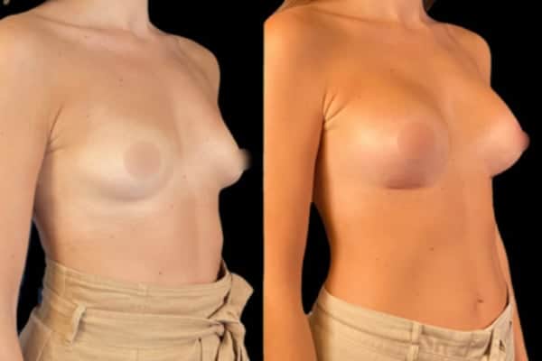 augmentation mammaire dual plan prix tarif chirurgie mammaire prothese mammaire docteur harold chatel chirurgien esthetique paris 16