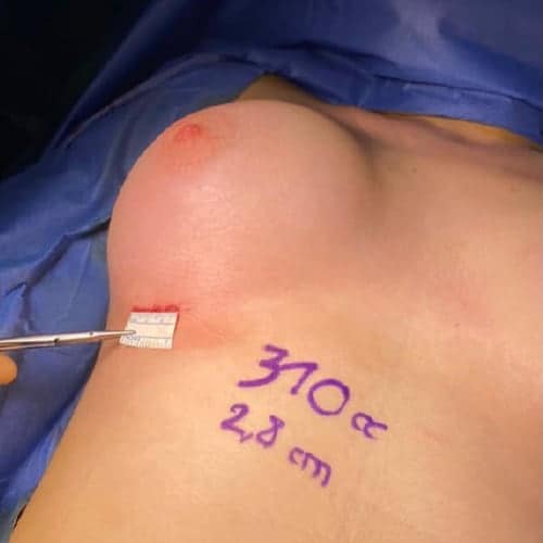 cicatrisation sous mammaire evolution douleur cicatrice sous mammaire augmentation mammaire cicatrice docteur harold chatel chirurgien esthetique paris 16