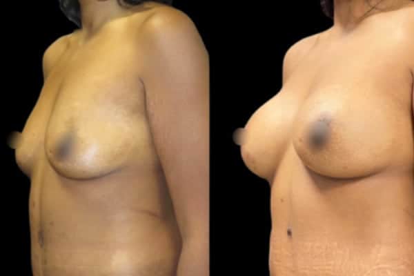 femme bonnet d augmentation mammaire bonnet dd prothese mammaire 85d docteur harold chatel chirurgien esthetique paris 16