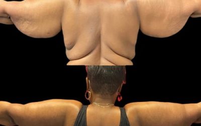 Lifting des bras