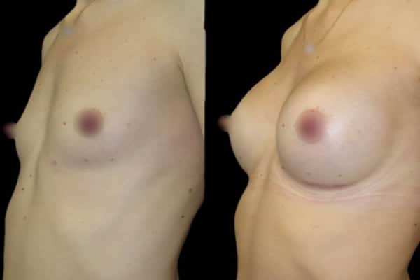 quel bonnet choisir taille bonnet c seins augmentation mammaire taille naturelle docteur harold chatel chirurgien esthetique paris 16