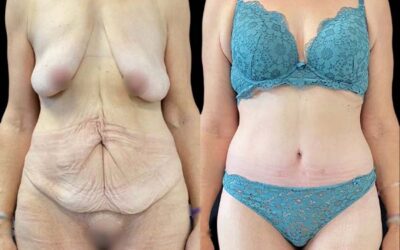 Bodylift avant après, avis et prise en charge à Paris 16