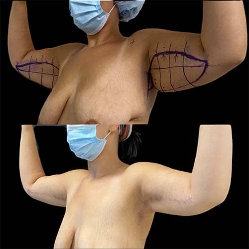 exercices pour les bras qui pendent solution brachioplastie dr harold chatel chirurgien esthetique paris 16