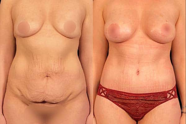 mommy makeover bodylift et lipofilling mammaire dr harold chatel chirurgien esthetique paris 16
