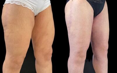 Lifting des cuisses (cruroplastie) : prise en charge, avis et photos