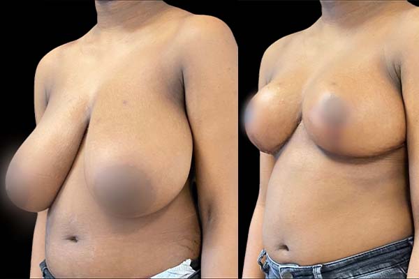 Réduction mammaire : tarifs