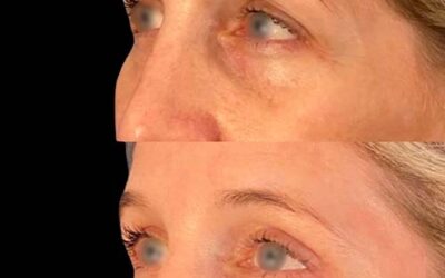 La blépharoplastie des paupières supérieures