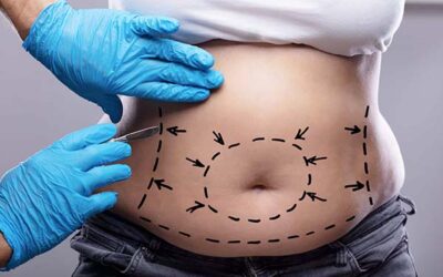 Abdominoplastie ratée : quelles solutions ?