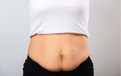Abdominoplastie et grossesse
