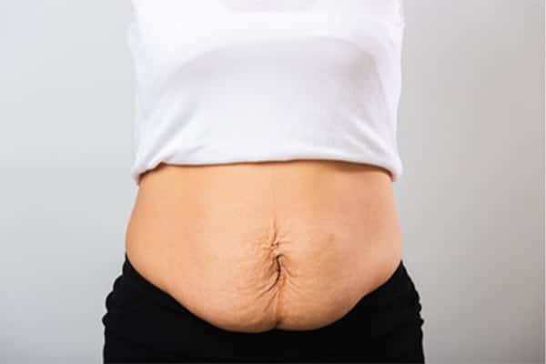 Abdominoplastie et grossesse