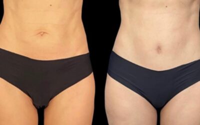 Abdominoplastie vs mini abdominoplastie
