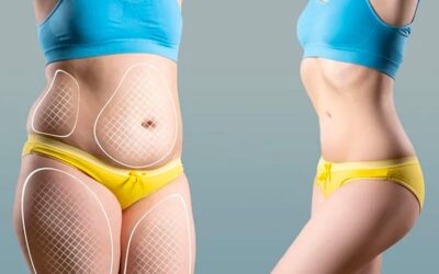 Bodylift : l’opération du engendre-t-elle une douleur ?