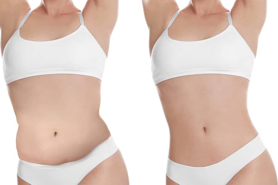 Quelles sont les conditions de prise en charge d’une abdominoplastie en France ?