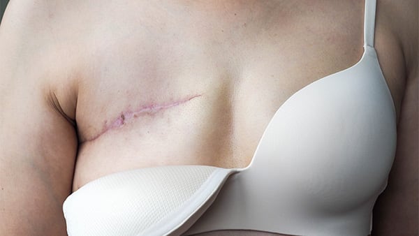 reconstruction mammaire par prothese reconstruction mammaire par injection de graisse cancer du sein homme ablation du sein docteur harold chatel chirurgie esthetique sein paris 16